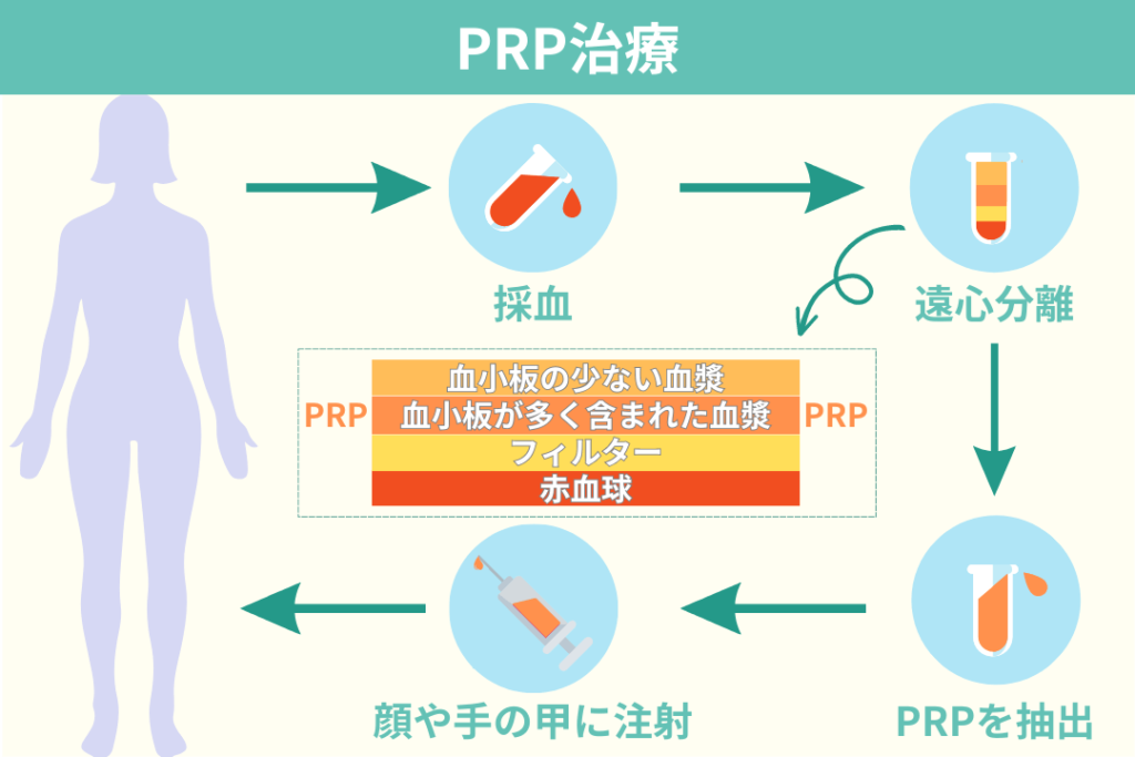 PRP治療の流れ